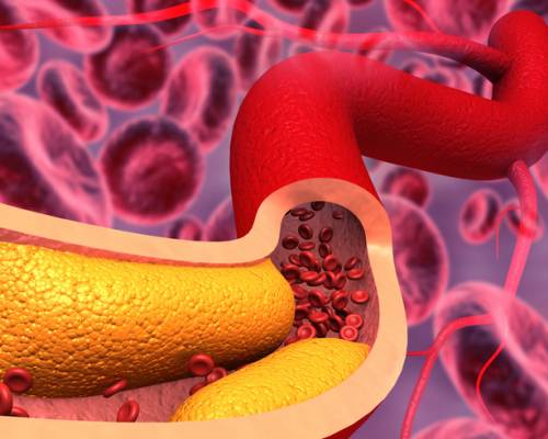 El colesterol i com afecta al cor